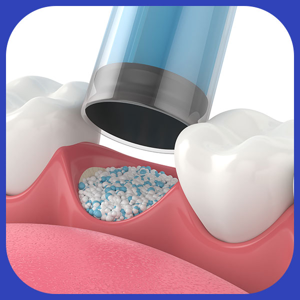 Pre-Implant-Bone-Graft